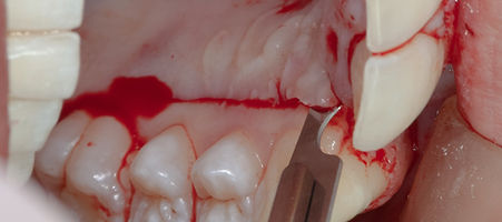 Compromized Implants .033.jpeg