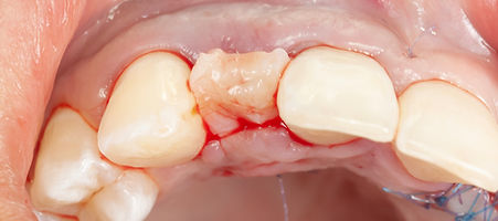 Compromized Implants .113.jpeg