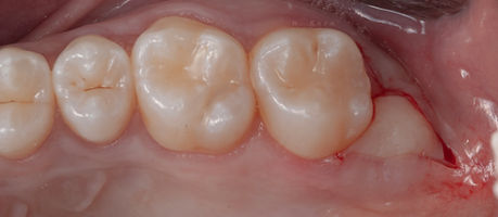Compromized Implants .080.jpeg