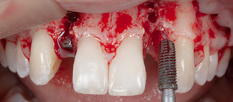 Compromized Implants .018.jpeg
