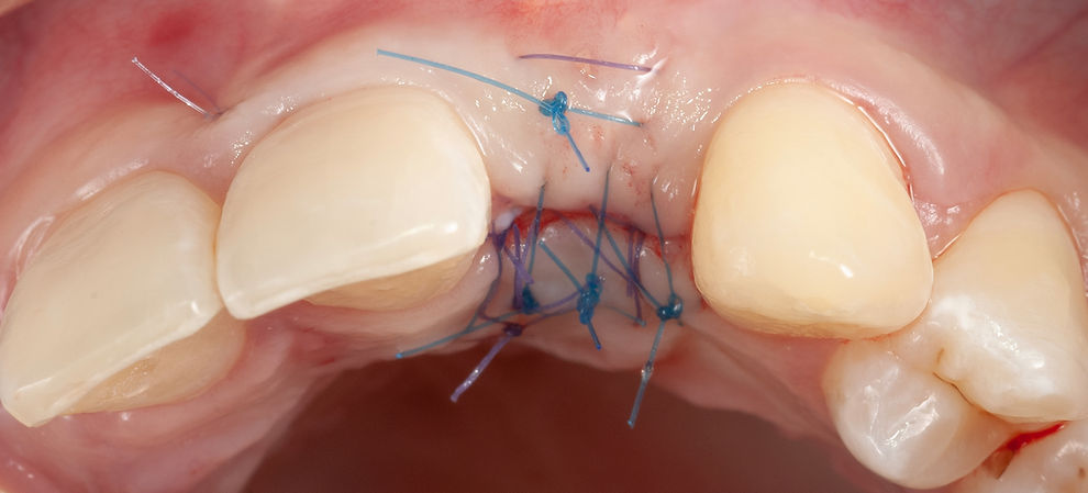 Compromized Implants .103.jpeg
