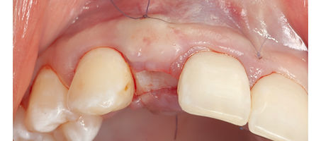Compromized Implants .118.jpeg