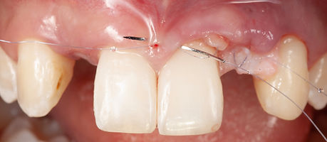 Compromized Implants .101.jpeg