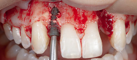 Compromized Implants .020.jpeg