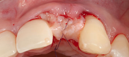 Compromized Implants .100.jpeg