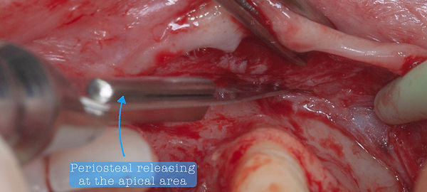 Compromized Implants .043.jpeg