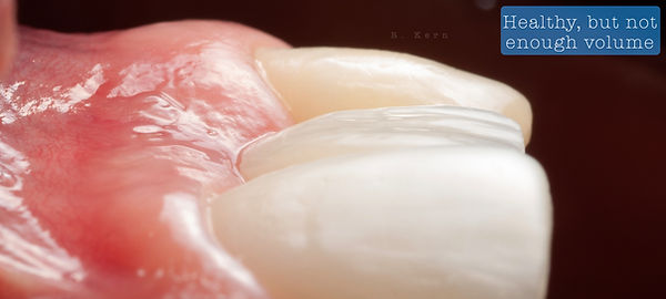 Compromized Implants .075.jpeg