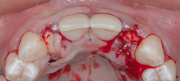 Compromized Implants .067.jpeg