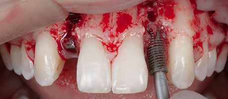 Compromized Implants .017.jpeg