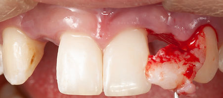 Compromized Implants .094.jpeg