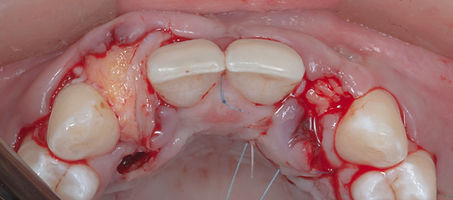 Compromized Implants .065.jpeg