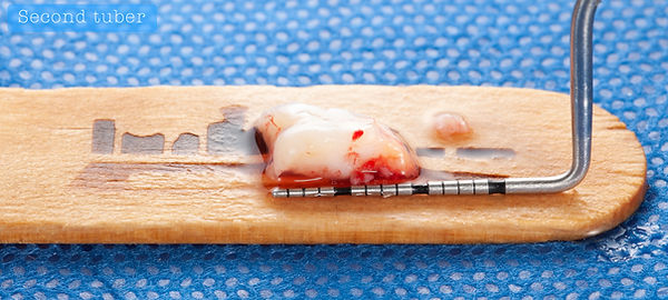 Compromized Implants .104.jpeg