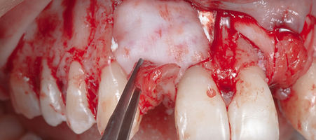 Compromized Implants .054.jpeg
