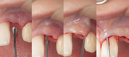 Compromized Implants .091.jpeg