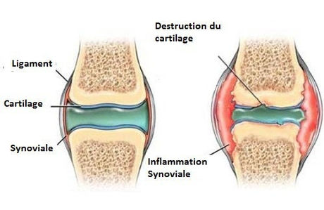 Arthrose du genou
