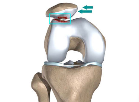 Schéma d'un genou utilisé par un ostéopathe à paris dans le cadre d'un article de blog consacré au syndrome rotulien