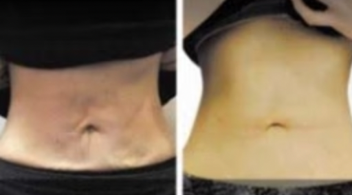 Thumbnail: PB Serum Lift ( Collagenase, DMAE 3%, Vit C 20%) - 2 vials
