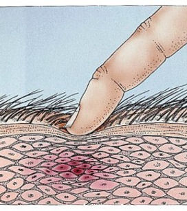 Trigger Point Drawing - Balance in Motion Bodywork, Santa Barbara Massage Therapy