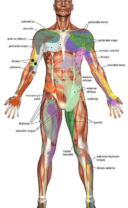 Trigger Point Map, Front - Balance in Motion Bodywork, Santa Barbara Massage Therapy