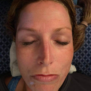 Facial Treatments and Acne Care