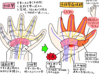 ◆指先の痺れ　手根管症候群