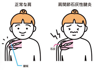 ◆夜中の肩痛　石灰沈着性腱板炎　