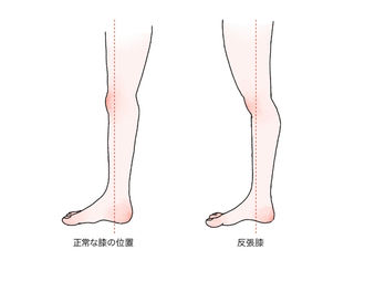 ◆ヒール靴が原因かも　反張膝
