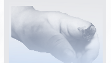 AMPUTACION TRAU.png