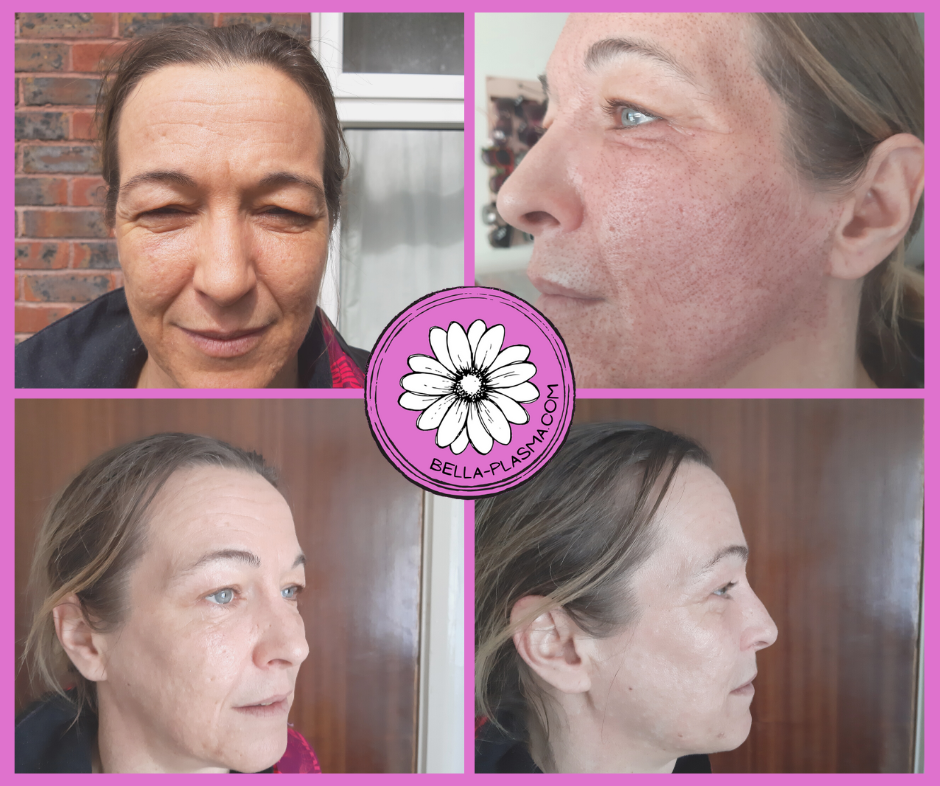 Plasma pen treatment on face - non-surgical facelift