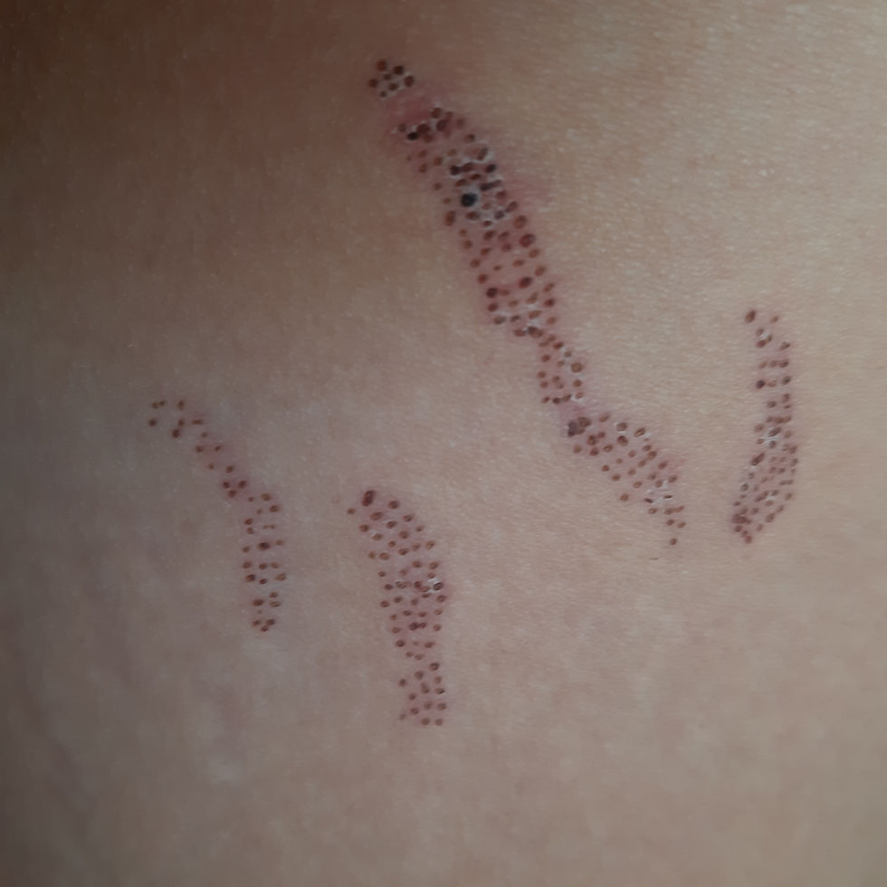 Plasma pen treatment on stretch marks