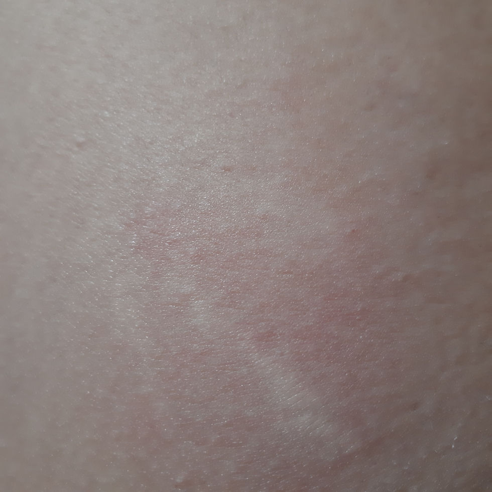 Plasma pen treatment on stretch marks