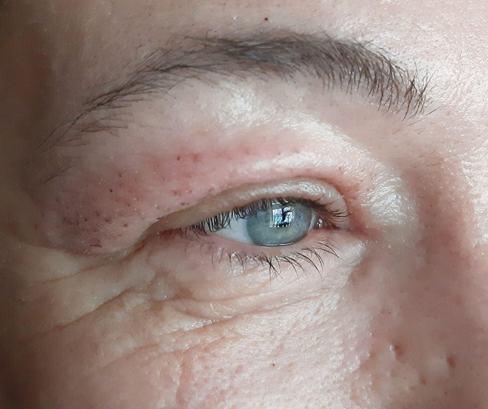 Plasma Pen treatment on eyelids