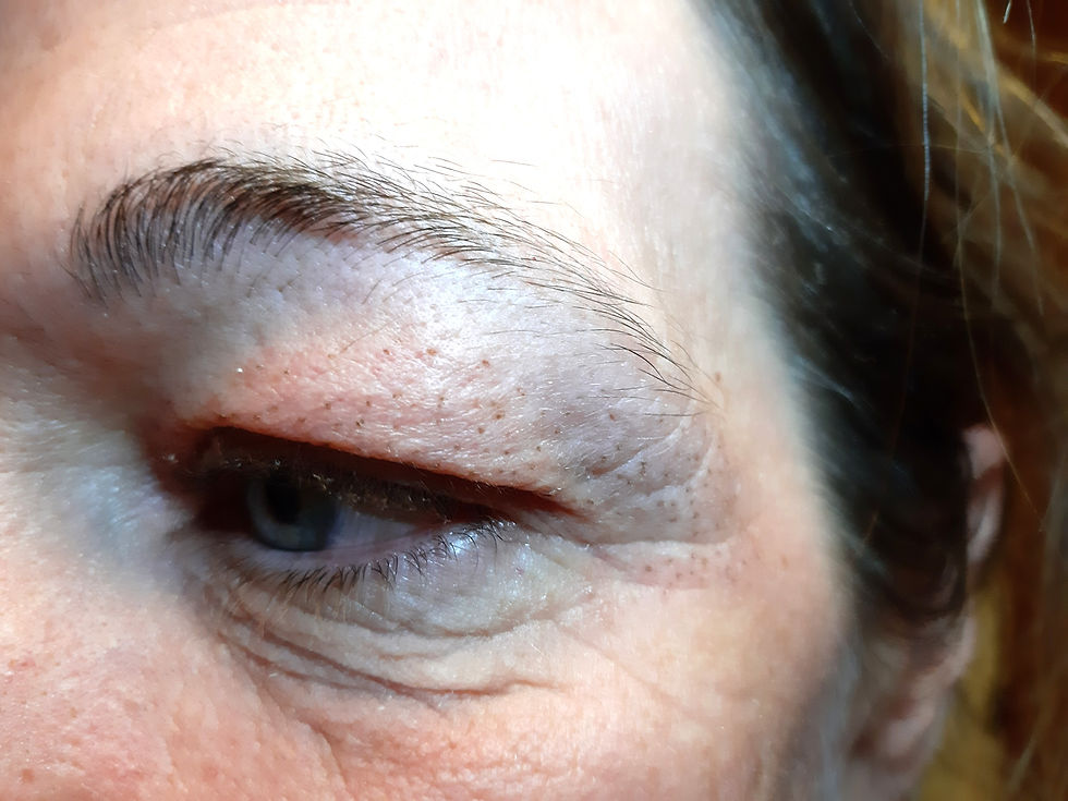 Plasma pen treatment on upper eyelids first