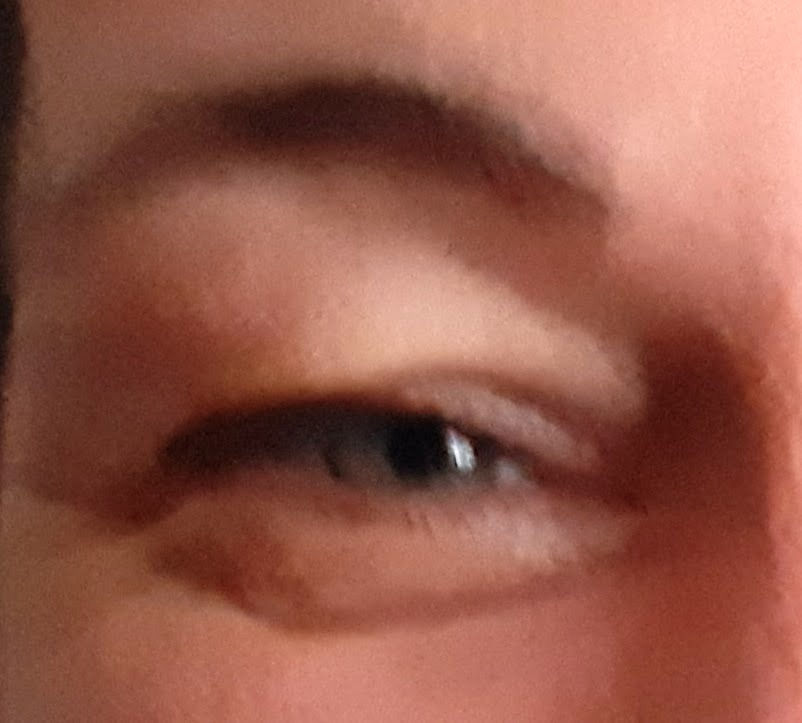 Before Plasma Pen treatment on eyelids