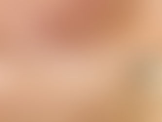 ハーブピーリングでニキビ改善