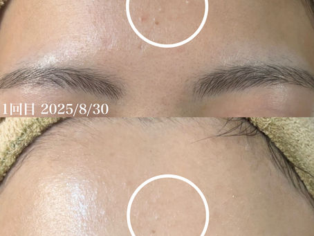 REVIハーブピーリング2週間での変化