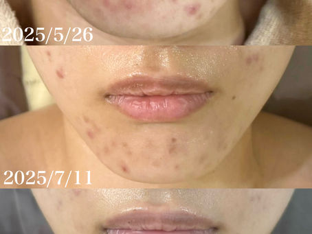 ハーブピーリングでニキビ改善