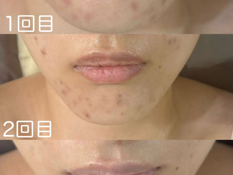 ハーブピーリングでニキビ跡改善