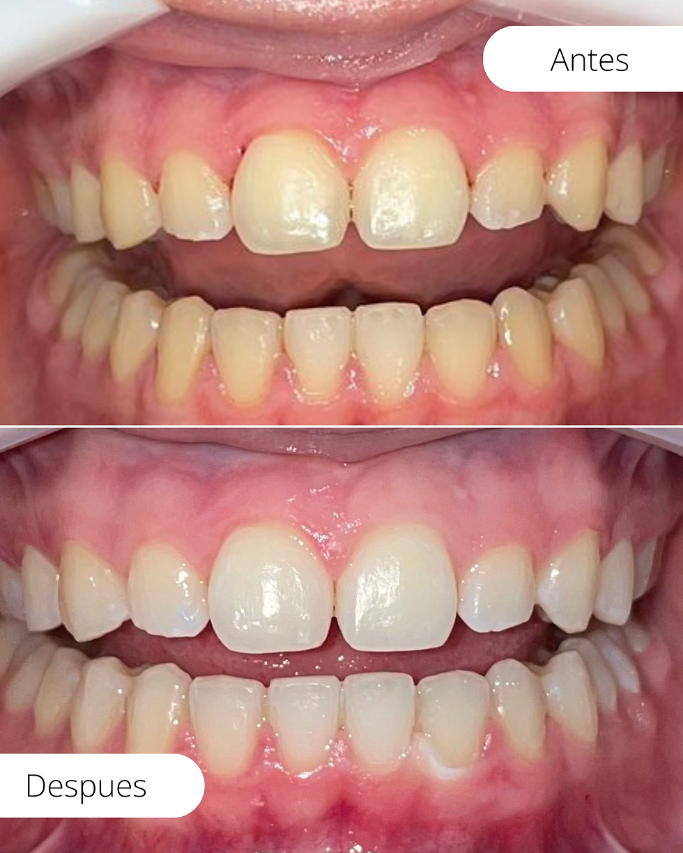 Resultado real de blanqueamiento dental - Antes y Después - Clínica Dental K2