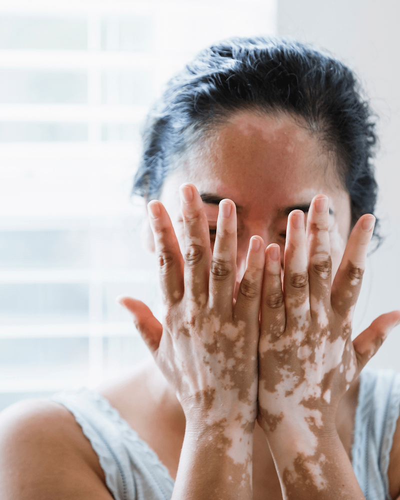 Whit Skin From White Patches to Confidence: Latest Vitiligo Treatments You Should ...