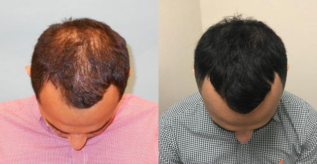 PRP Therapy for Hair Loss in Bangalore