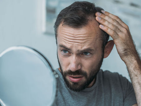 Male Pattern Baldness Treatment