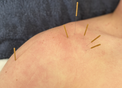 Dry needling for the shoulder is a targeted technique designed to relieve pain and improve mobility in the shoulder muscles.