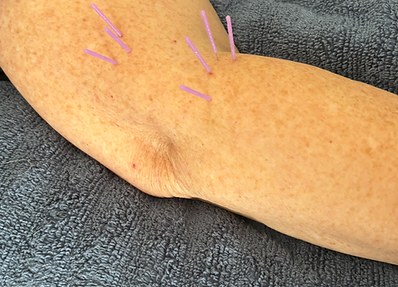 Dry needling for elbow tendonitis is a specialized treatment designed to reduce pain and inflammation associated with golfer’