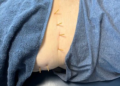 Dry needling for the upper back and trapezius targets tight muscles and trigger points to relieve pain and improve mobility.