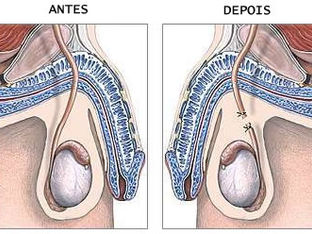 Vasectomia..
