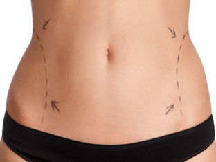 Lipoaspiração - você conhece os riscos por trás da silhueta perfeita