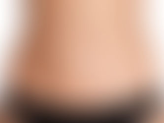Lipoaspiração - você conhece os riscos por trás da silhueta perfeita