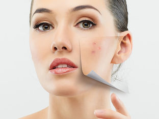 Acne: saiba o que fazer...