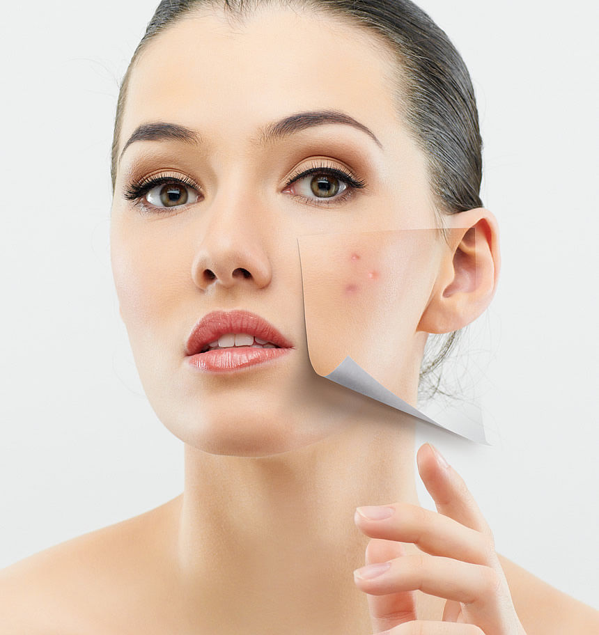 acne-mitos.jpg